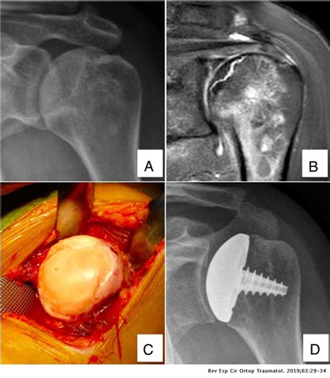 Results Of Partial Resurfacing Of Humeral Head In Patients With