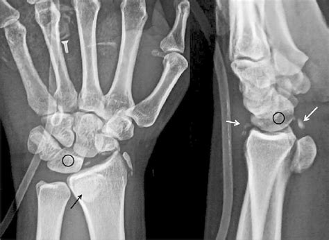Frontal And Lateral Wrist Radiograph Showing Evidence Of