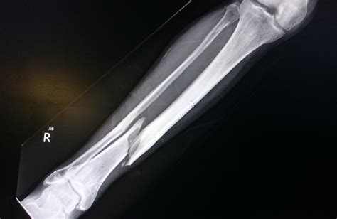 Tibia Fracture Types Symptoms And Treatment 2023