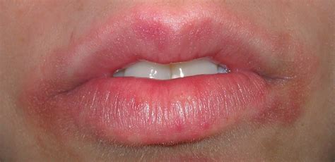What Causes Rash And Swollen Lips Just