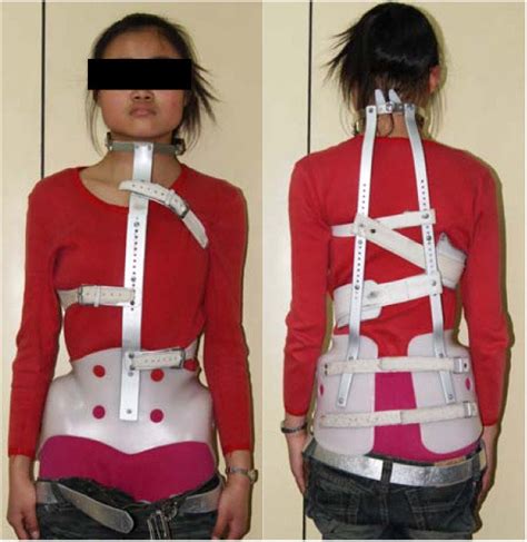 The Same Patient Wearing Milwaukee Brace The Neck Ring Cause A Download Scientific Diagram