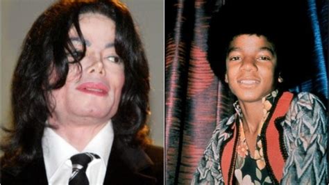 El Vitíligo La Enfermedad De Piel Que Padecía Michael Jackson
