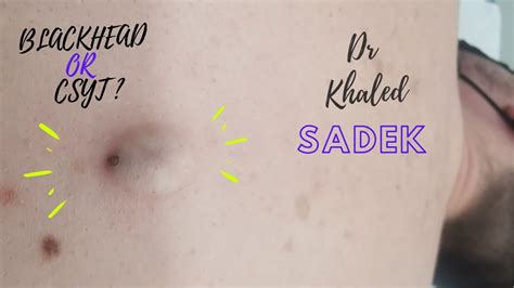 Blackhead Or Cyst Dr Khaled Sadek Youtube