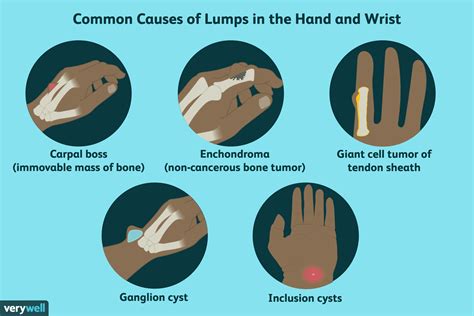 Causes Of Lumps And Bumps On The Hands And Wrists
