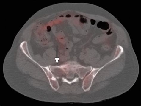 Whole Body Imaging Of Multiple Myeloma Diagnostic Criteria Radiographics