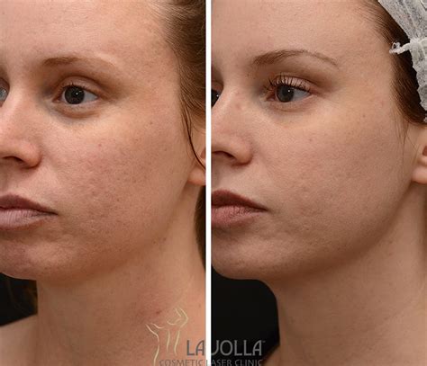 Treating Acne Scars A New Way La Jolla Cosmetic Laser Clinic