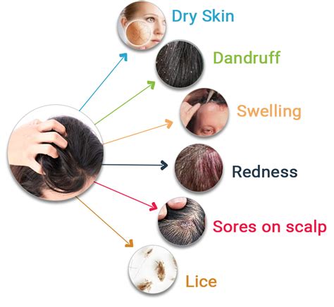 Itchy Scalp Dont Scratch Use These Insightful Remedies To Treat