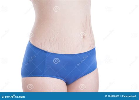 Woman Belly Skin With Stretch Mark Scar Over White Stock Image Image Of Care Female 104968465