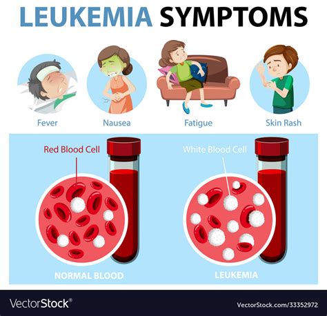 Leukemia Symptoms Cartoon Style Infographic Vector Image