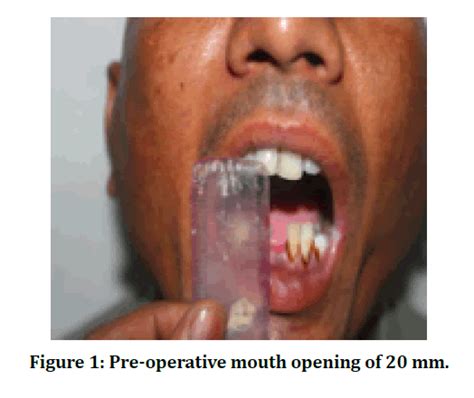 Medical Dental Mouth Opening