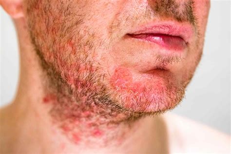 Causes Symptoms And Treatment Of Folliculitis