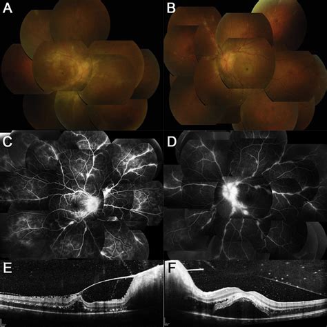 Color Fundus Photographs A B Fluorescein Angiography C D And