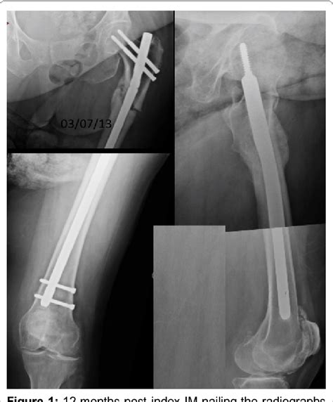 Figure 1 From Surgical Management Of An Atypical Femoral Non Union