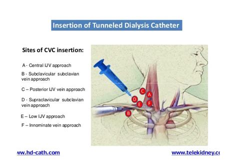 Tunneled Catheter Advantages