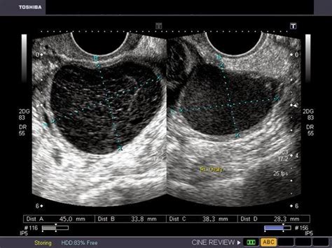 Learn about treatment, causes, stages, surgery, and diagnosis. KL Gynaecologist @ Gleneagles Medini: SISTA OVARI (OVARIAN ...