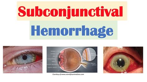 Subconjunctival Hemorrhage Diagram
