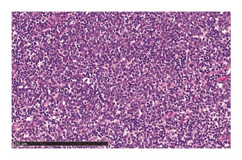 Histological Findings In A Patient With Igg4 Related Lymphadenopathy