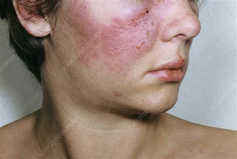 Lupus Erythematosus On The Face Stock Image C0131028 Science