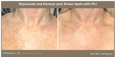 Neck Rejuvenation Brown Spots And Age Spots Cosmetic Skin Care