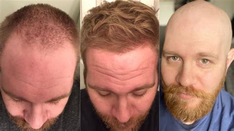 This Guy Completely Reversed Hair Loss But Went Bald Again Heres Why