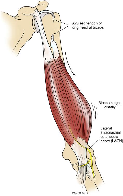 Lateral Antebrachial Cutaneous Nerve Compression Afte