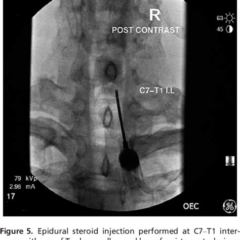 Mri Cervical Spine Without Contrast Showing Mild Multisegmental