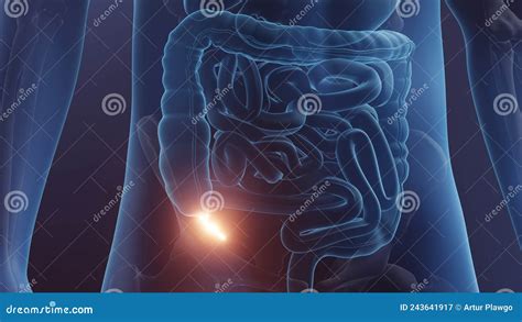 Appendix In Human Body Appendicitis Concept Illustration Stock