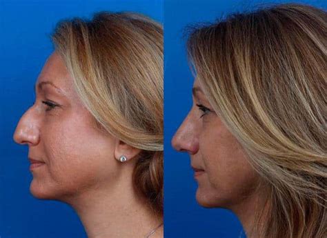 One Anti Aging Procedure You Wouldnt Expect Rhinoplasty Philip