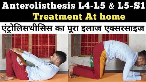 Anterolisthesis L5 S1 Treatment Anterolisthesis L5 S1 Exercises