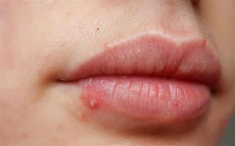 Natural And Easy Home Remedies To Get Rid Of A Lip Pimple Wardrobe Cult