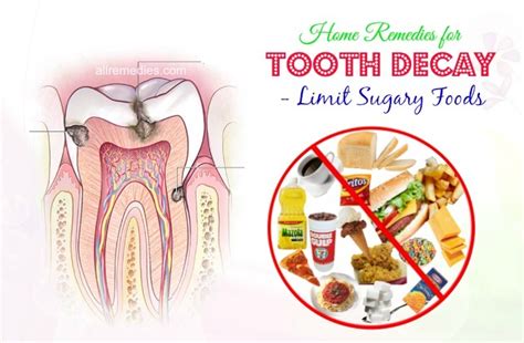 41 Home Remedies For Tooth Decay Causes Symptoms And Treatments