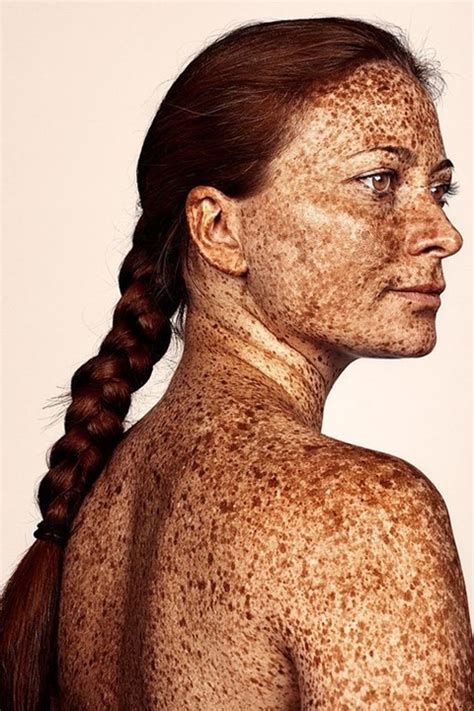 exploring the beauty and shame of freckles dazed