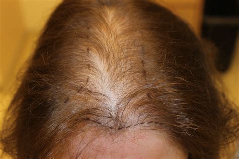 Telogen Effluvium Hair Loss Want Additional Info Click On The Image
