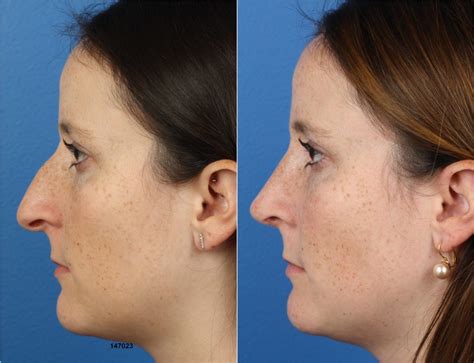 When To Choose A Nose Tip Surgery Over Full Rhinoplasty Philip