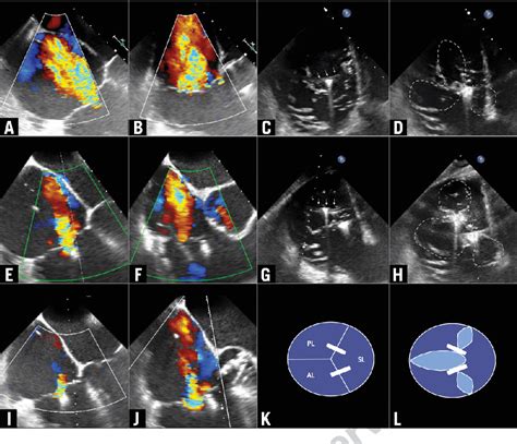 First Transfemoral Percutaneous Edge To Edge Repair Of The Tricuspid