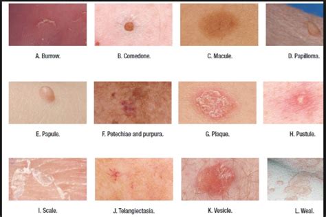 Skin Lesion Types For Nursing Students Dermatology Nurse Wound Care