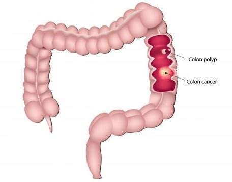 The confusion surrounding semicolon vs. Can You Show Pictures of Colorectal Cancer ...