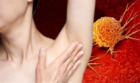 Cancer Symptoms Of Skin Cancer May Include Lumps Under The Armpit