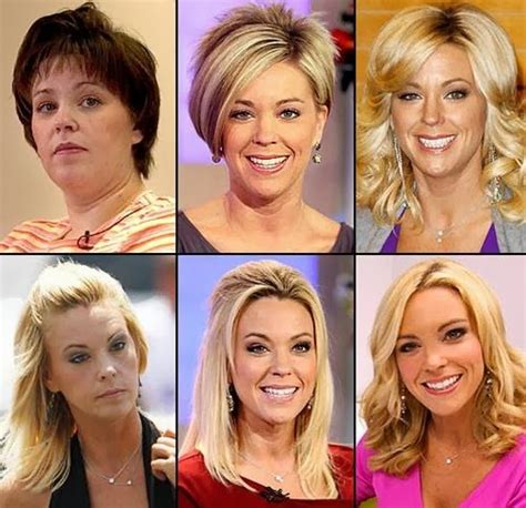 Kate Gosselin Plastic Surgery Before And After Tummy Tuck Pictures