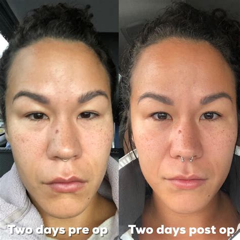 Why I Removed My Breast Implants + One Week Post Explant (Breast