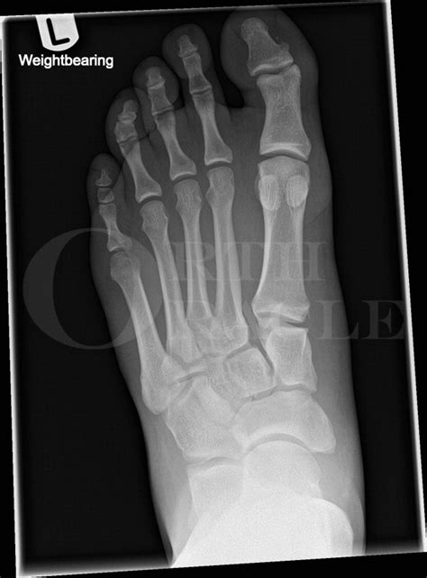 Lisfranc Fixation For Fracture Dislocation Injury Surgical Technique