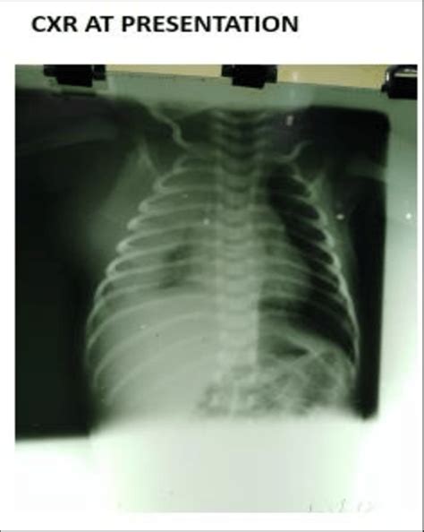 Chest X Ray Showing Blunting Of Right Costophrenic And Cardiophrenic