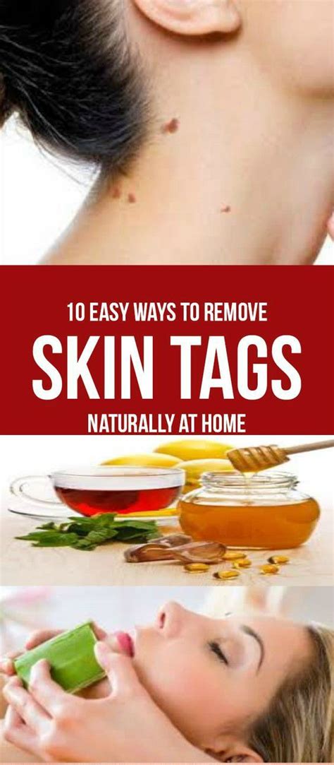 Home Remedies For Skin Tag Removal Skin Tags Home Remedies Home