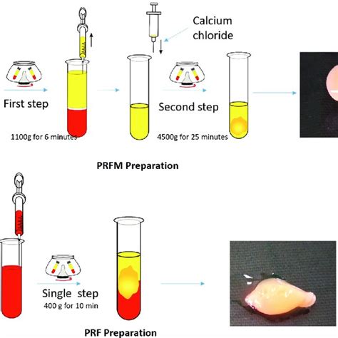 Pdf Evaluation Of Histological And Ph Changes In Platelet Rich Fibrin