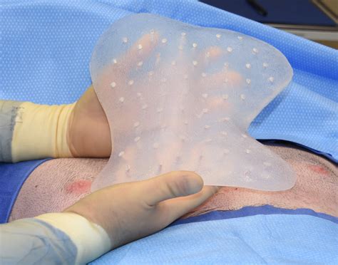 A community for discussion of pectus excavatum. OR Snapshots - Custom Chest Wall Implant for Pectus ...