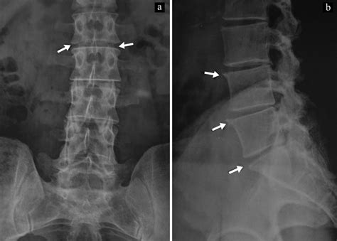 Radiograph Of Lumbar Spine Ofmr Y Anteroposterior And Lateral View In