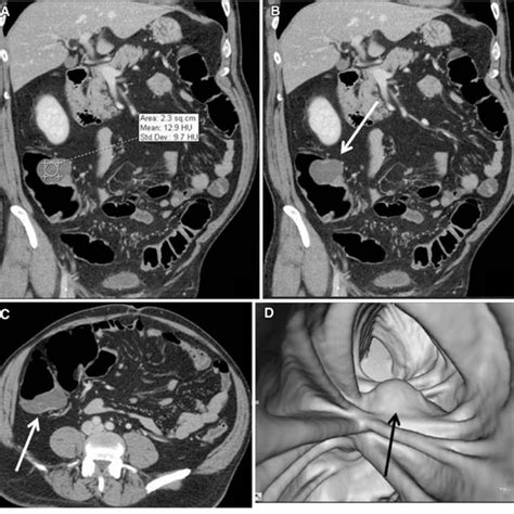 Gallbladder Lymphangioma A Axial Contrast Enhanced Ct Image Shows A