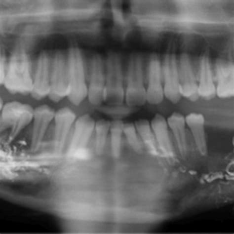 Panoramic Radiograph Following Bilateral Obliteration Of The Lesions In