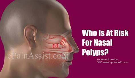 Nasal Polyps Sinus Infection