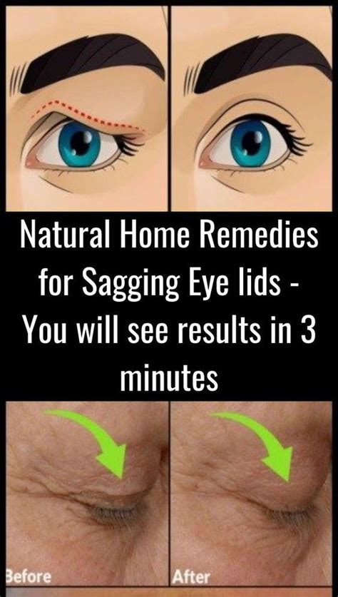 The Best Instant Remedy To Get Rid Of Sagging Eyelids Natural Home